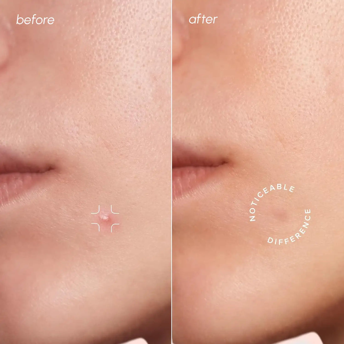 Invisible Pimple &amp; Acne Patches