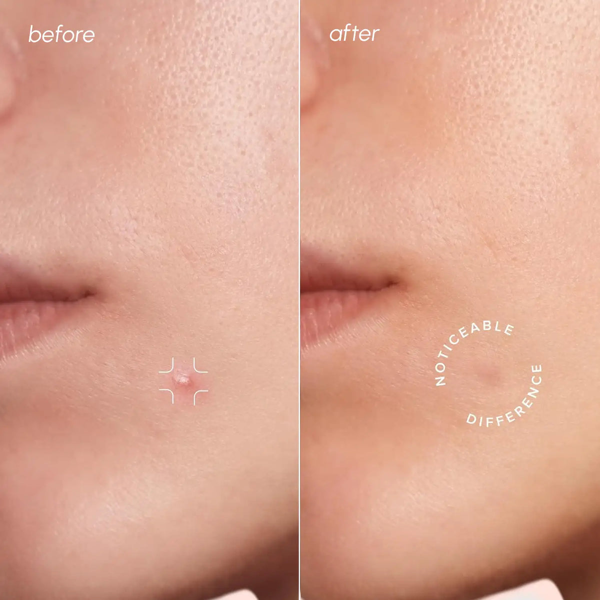Invisible Pimple &amp; Acne Patches