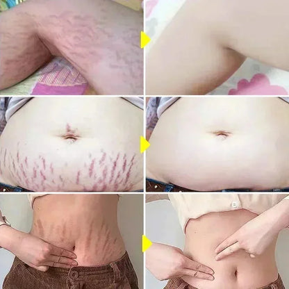 Cream For Pregnancy Stretch Marks Removal Eliminate Red White Old Stretch Marks 26