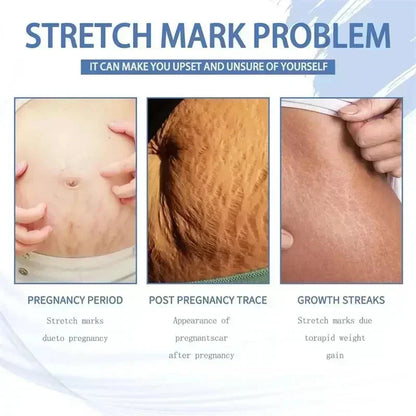 Cream For Pregnancy Stretch Marks Removal Eliminate Red White Old Stretch Marks 26
